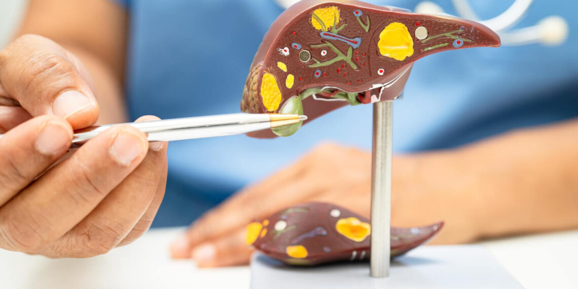 Fatty Liver Symptoms